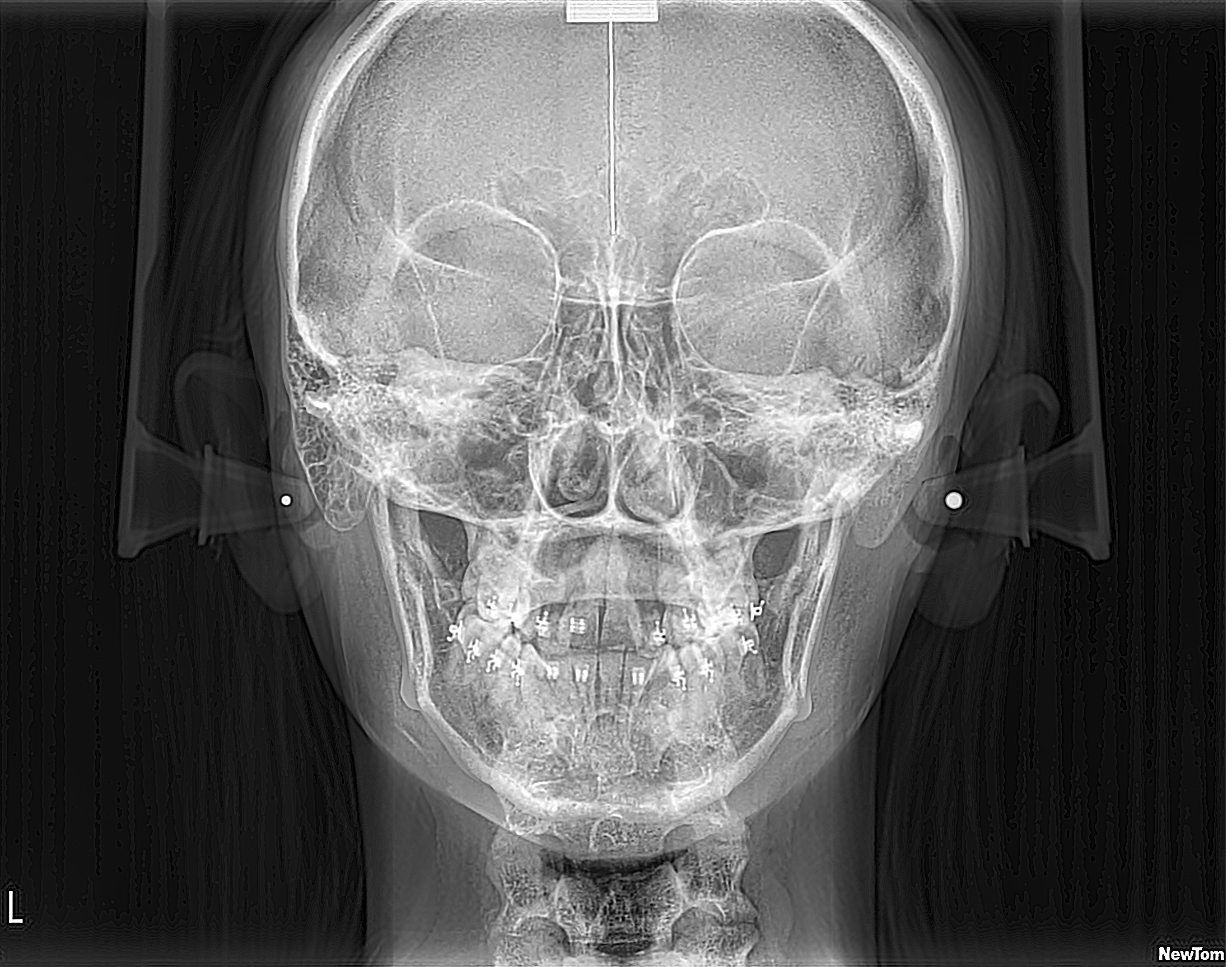 Telerradiografía Frontal