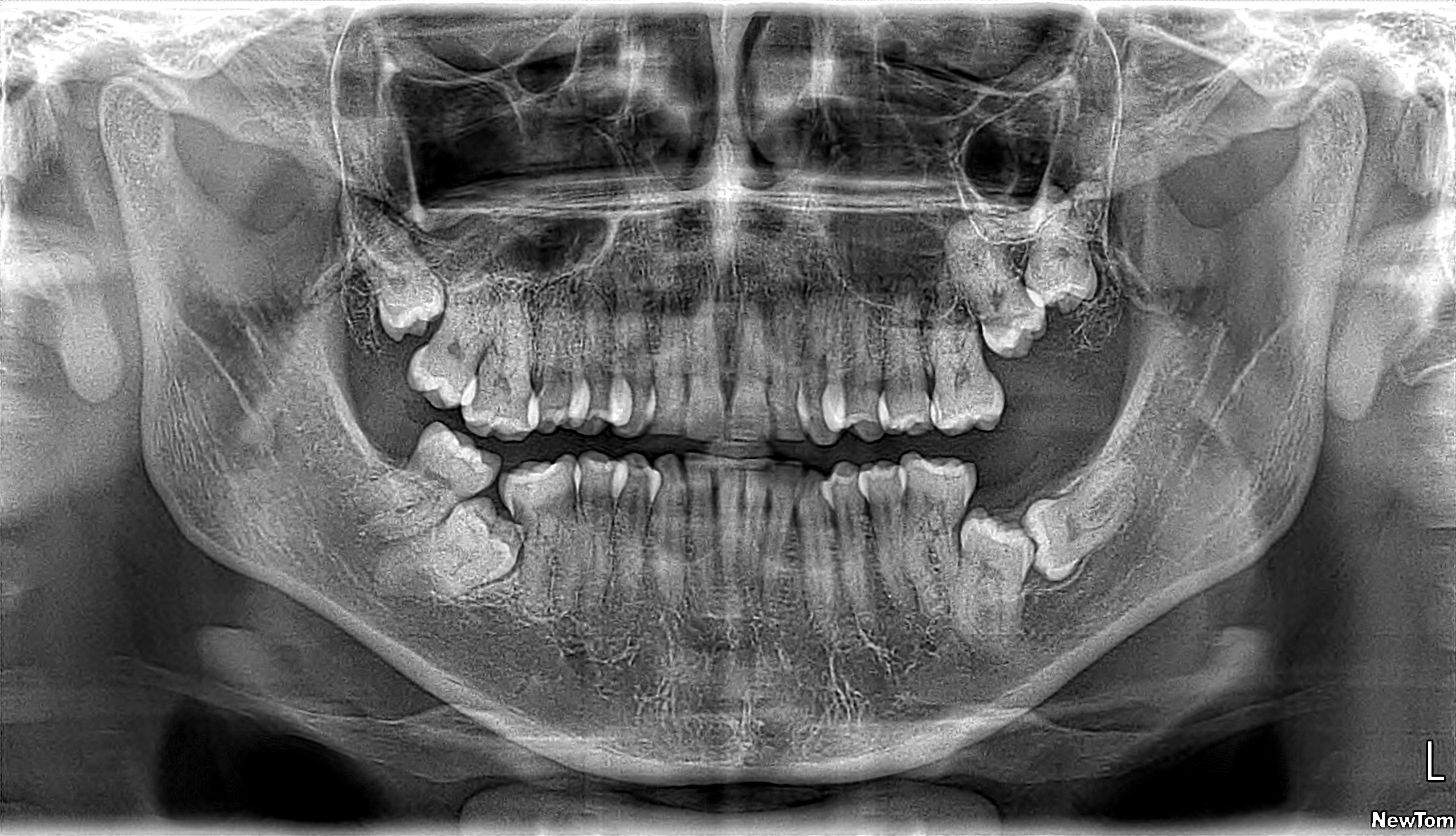 Radiografía Panorámica Dental